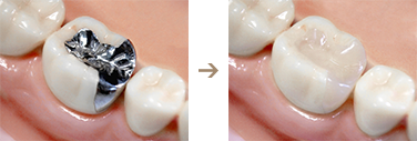 銀歯や変色した歯を改善