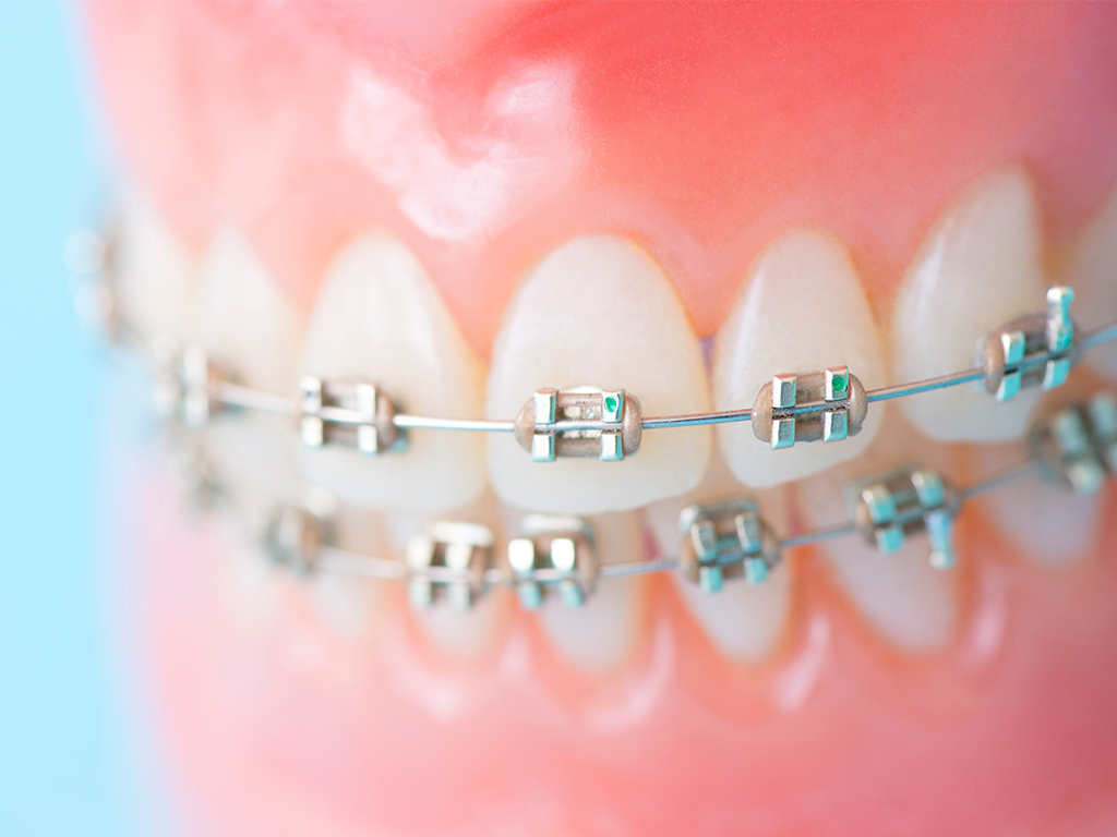 矯正治療中にブラケットが外れたらどうすれば良い？ ｜ 心斎橋駅の矯正